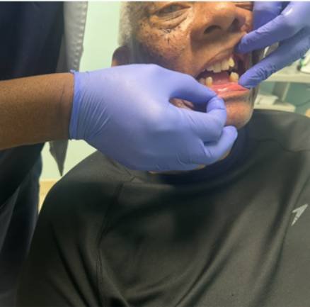 Before Photo – Removable Veneers _ Robert Before Photo - Removable Veneers _ Robert